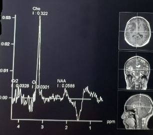 MR spectroscopy in GBM