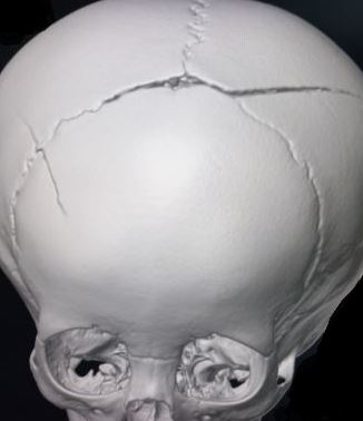 Fracture traversing the superior sagital sinus