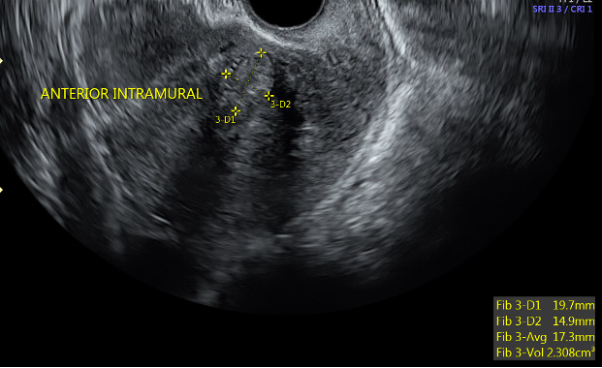 Transvaginal ultrasound sagittal image of a fibroid uterus