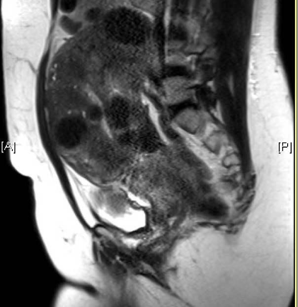 T2 sagittal MRI image of enlarged fibroid uterus