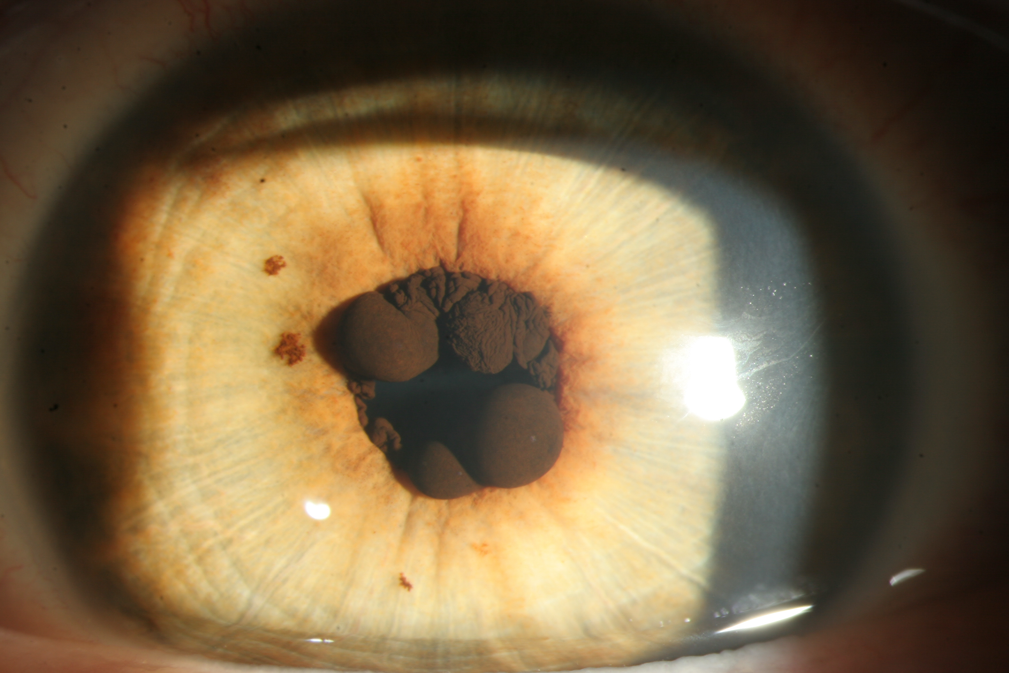 Central iris pigment epithelium cysts