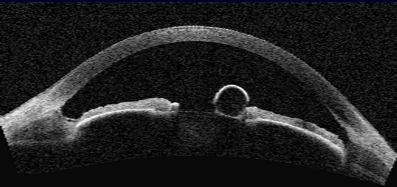 Anterior segment Ocular Coherence Tomography (AS-OCT) image of central iris pigment epithelium cyst