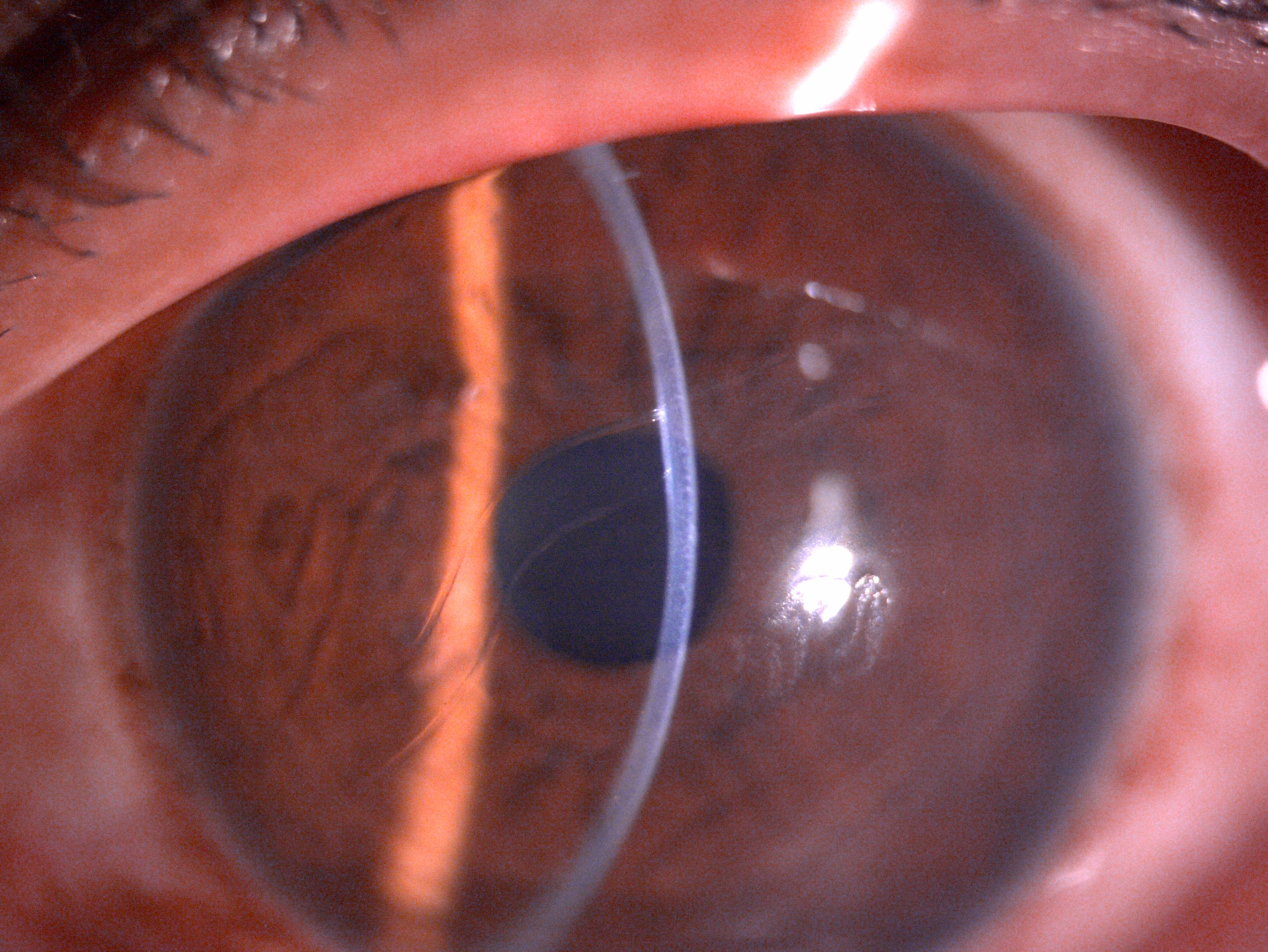 Slit lamp image of the child depicting megalocornea and horizontal oblique breaks in descemet membrane suggestive of Haab's s