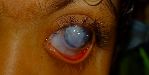 Slit lamp image of the child depicting mild conjunctival congestion, lower tarsal conjunctival hyperaemia, megalocornea, near