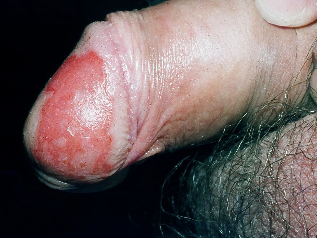 Balanitis. Inflammation of the glands of the penis.