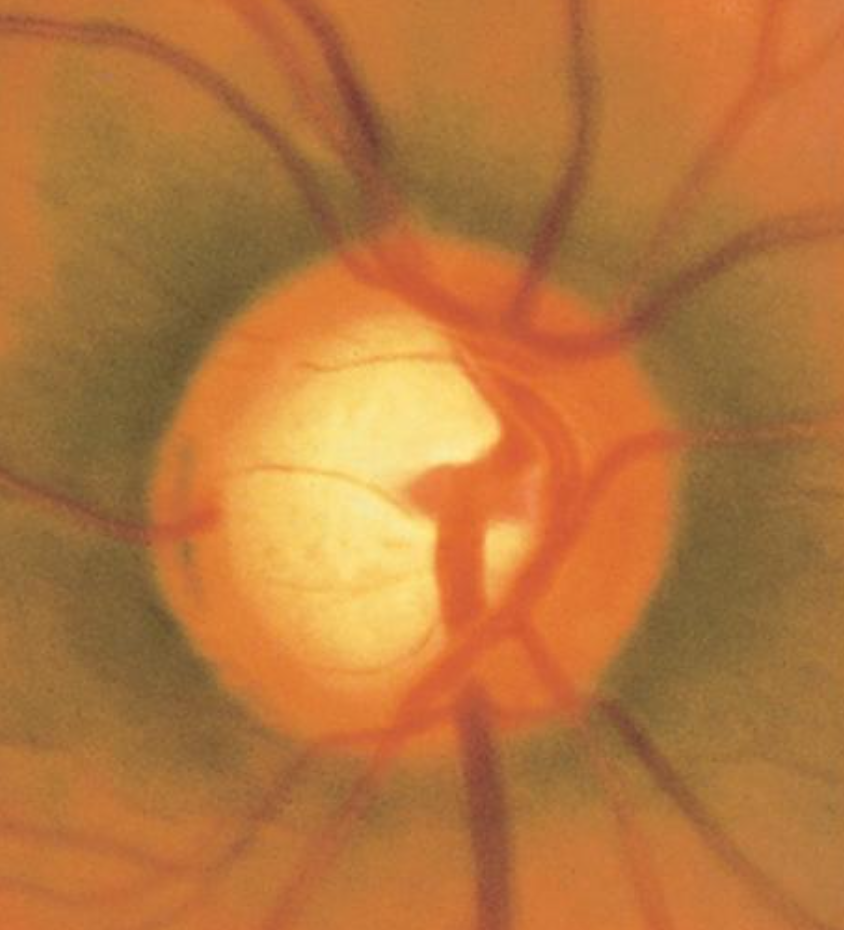 A zoomed-in fundus image showing a cup-to-disk ratio of 0