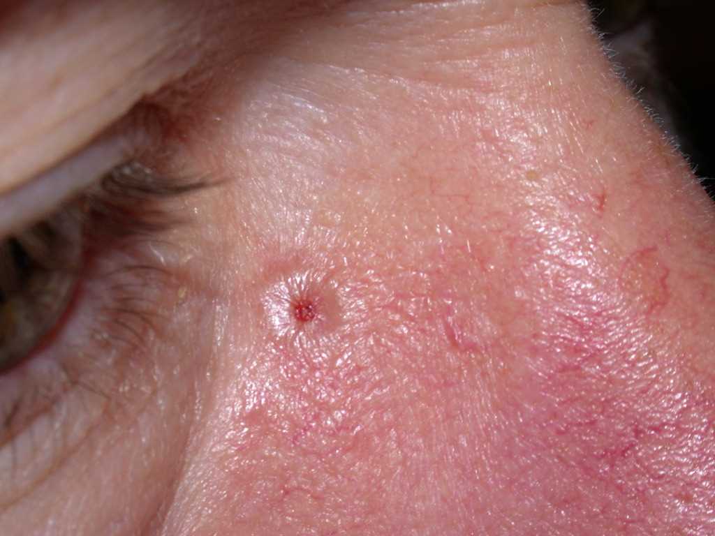 Nodulocystic Basal Cell Carcinoma