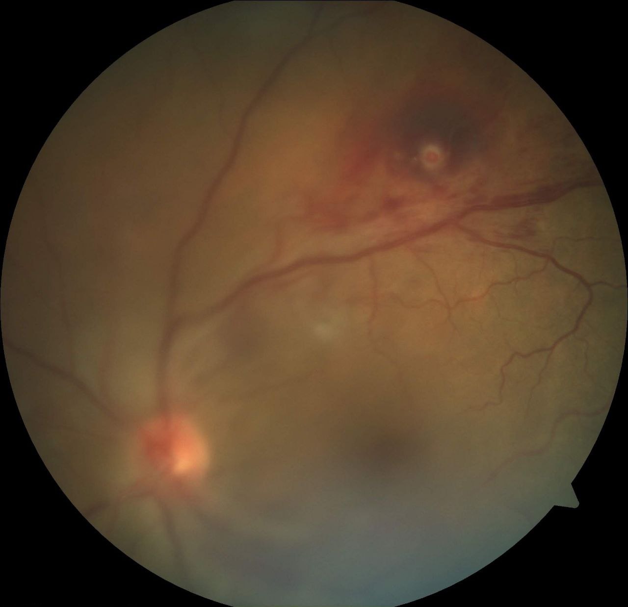 Color fundus image of the left eye shows media haze due to vitreous hemorrhage