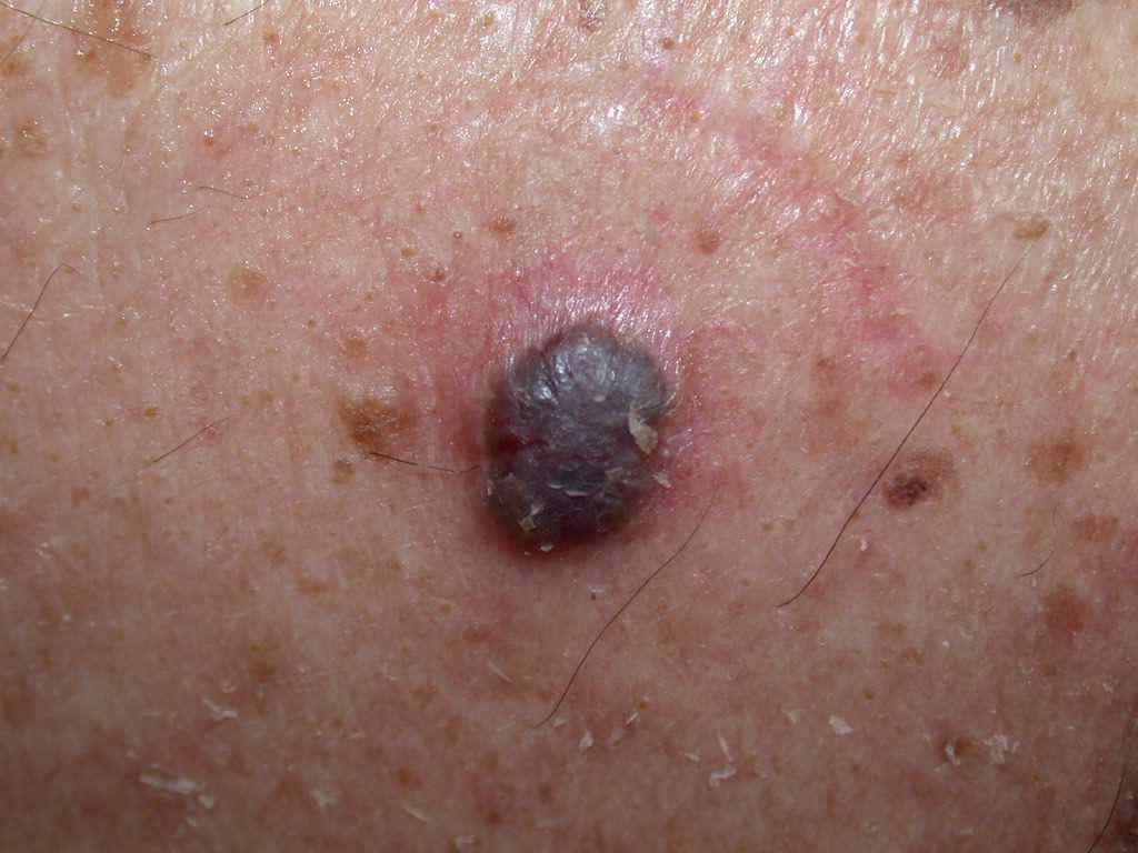 Pigmented Basal Cell Carcinoma