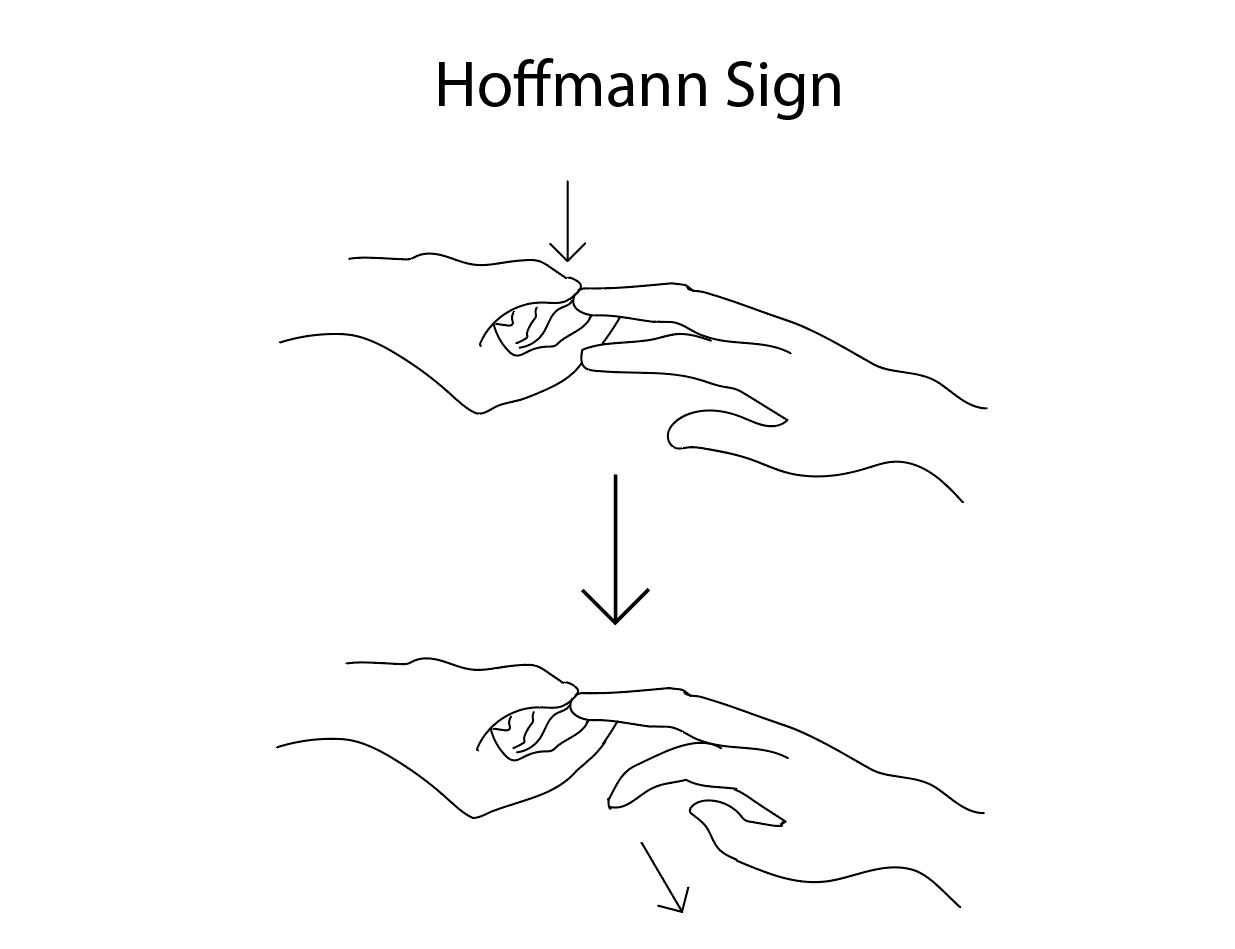 <p>Hoffmann Sign. This diagram depicts a positive Hoffmann sign, a standard part of the common neurologic exam.</p>