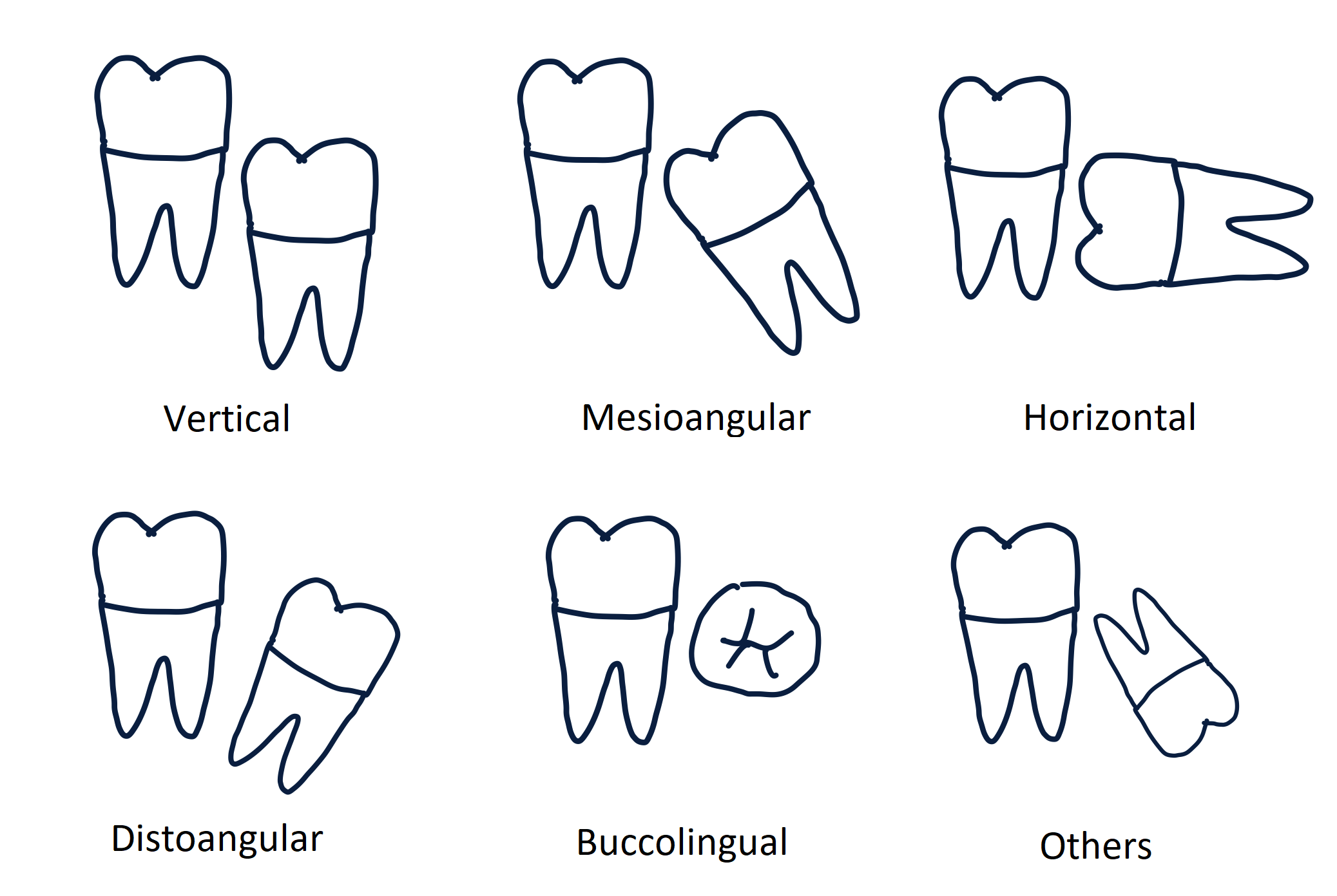 <p>Winter Classification of Third Molar Angulation</p>