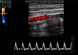 Normal Triphasic Arterial Waveform