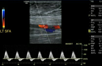 Biphasic Arterial Waveform