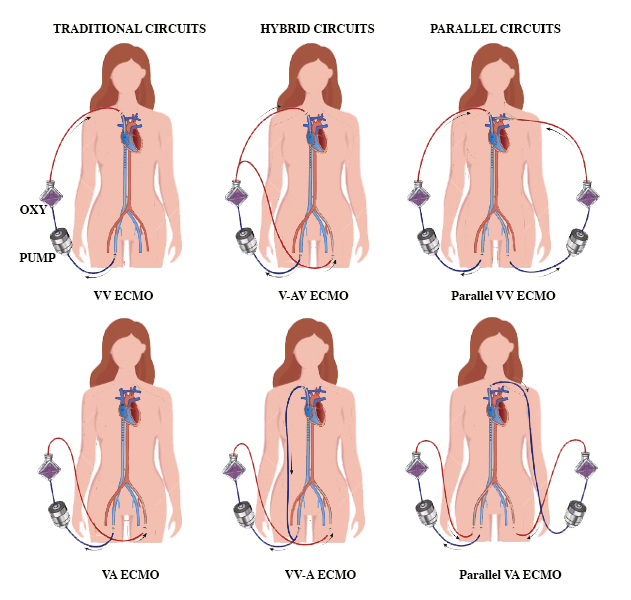 Types of ECMO circuit