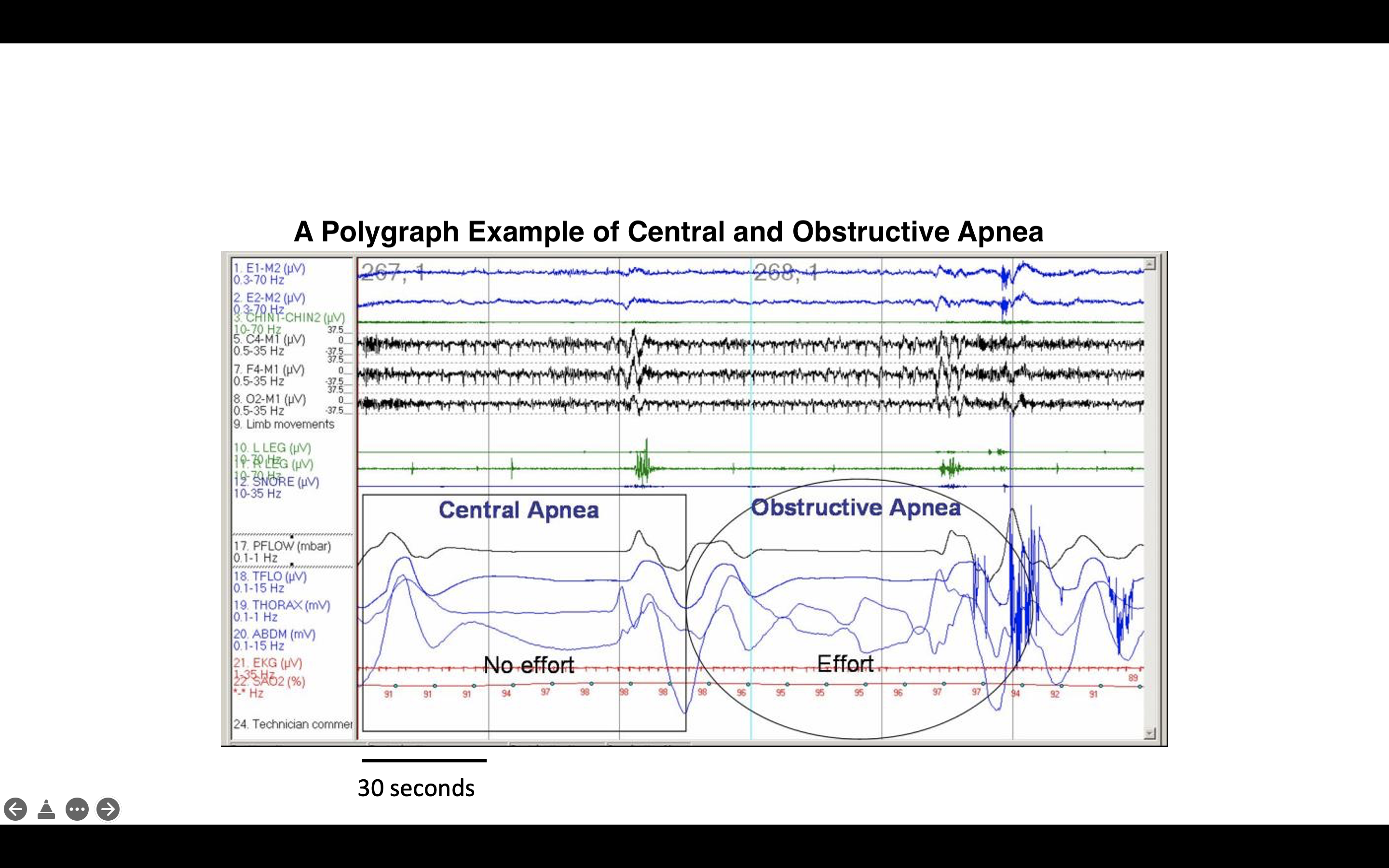 A polygraph depicting example of central and obstructive apnea.