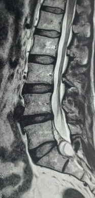 Tarlov cyst