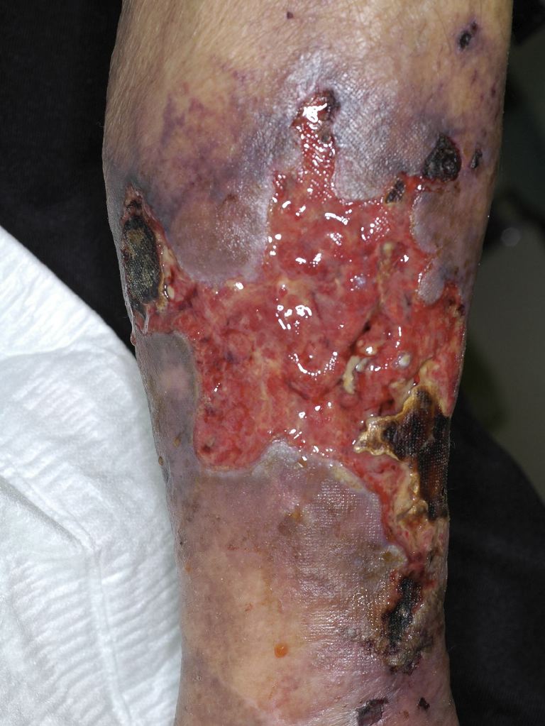 Calciphylaxis