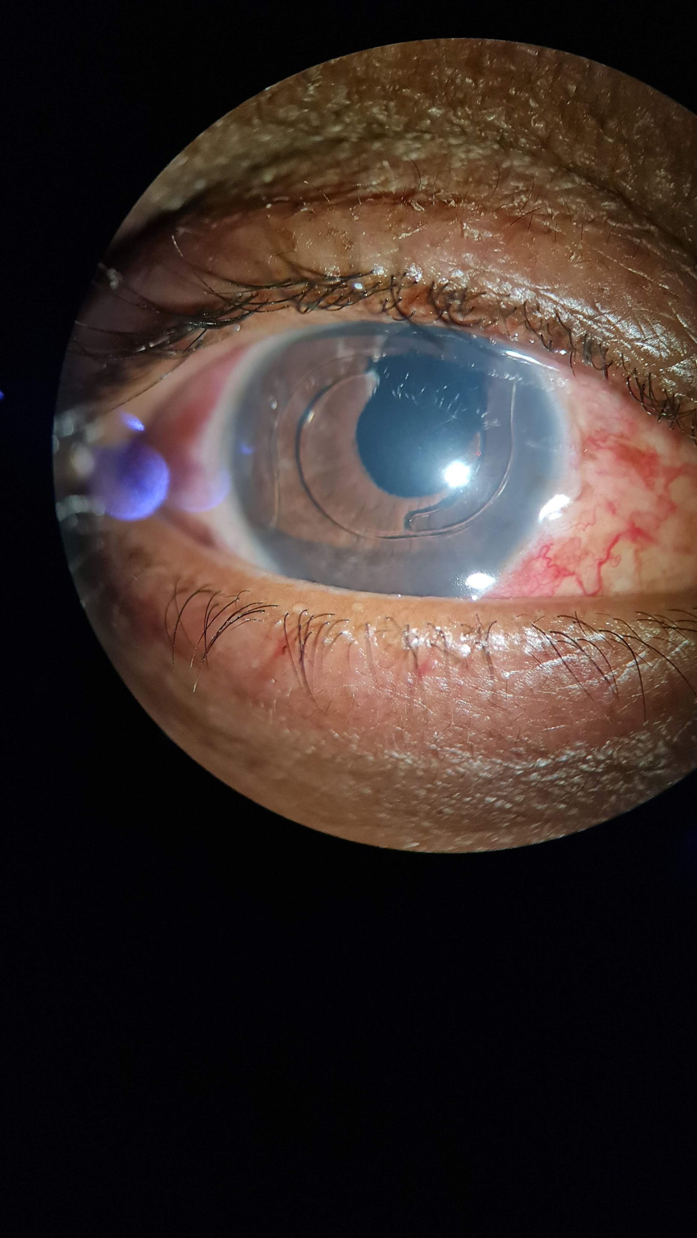 Uveitis Hyphema Glaucoma Syndrome
Anterior Chamber Intraocular Lens
Iridectomy