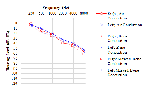 Audiogram, Presbycusis