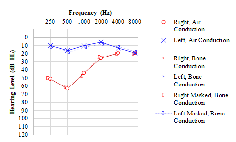 Unilateral, up-sloping sensorineural hearing loss is most commonly seen with Meniere disease.