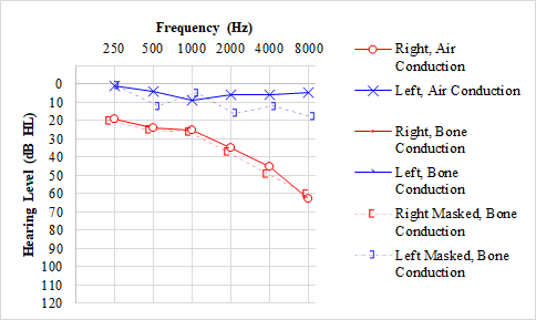 Audiogram with unilateral sensorineural hearing loss, typically found with vestibular schwannoma/acoustic neuroma.