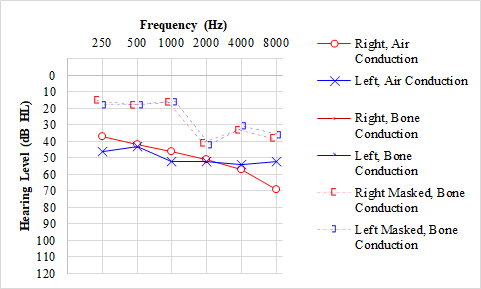 Audiogram showing bilateral mixed hearing loss in a patient with otosclerosis