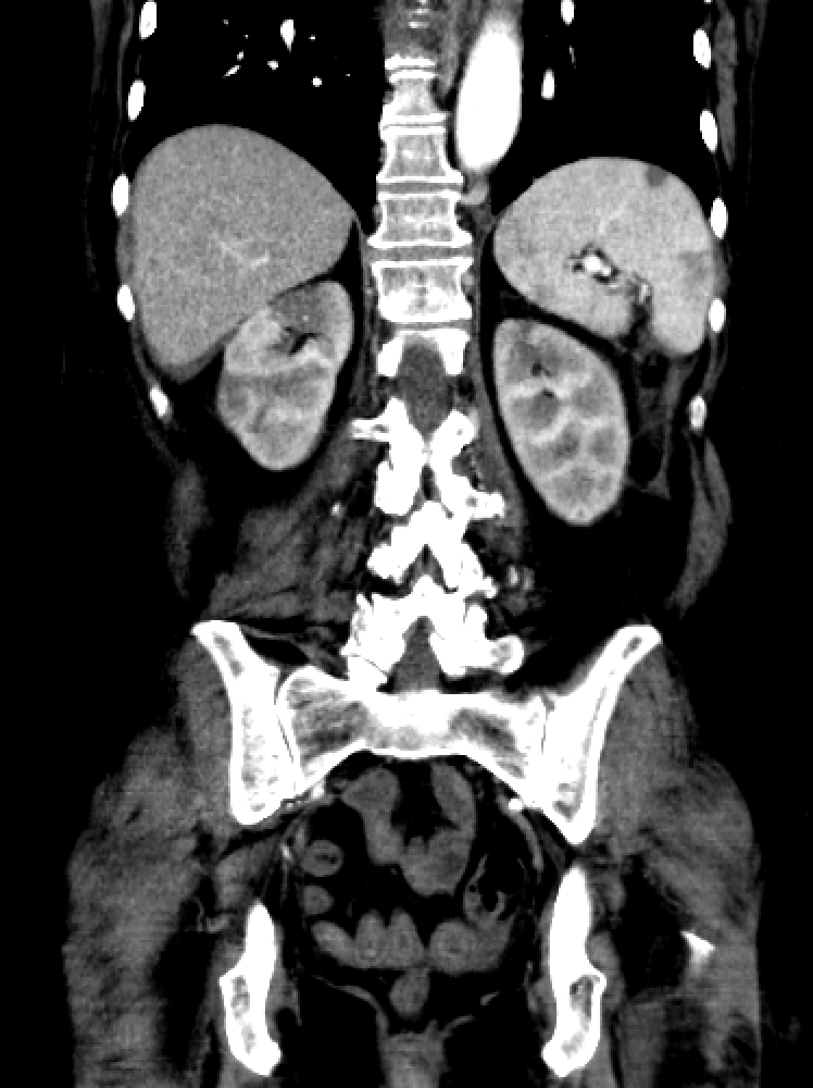 Renal infarction