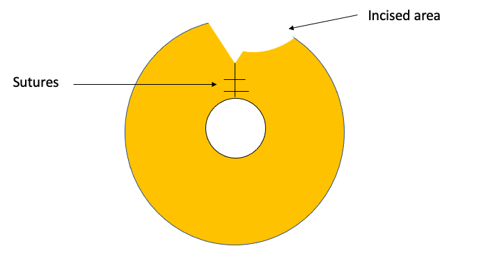 Schematic diagram depicting closure of an iridodialysis by circumferential incisional technique