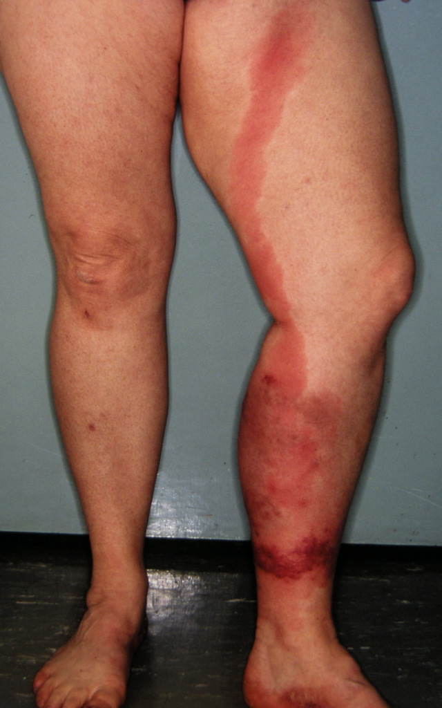 Cellulitis