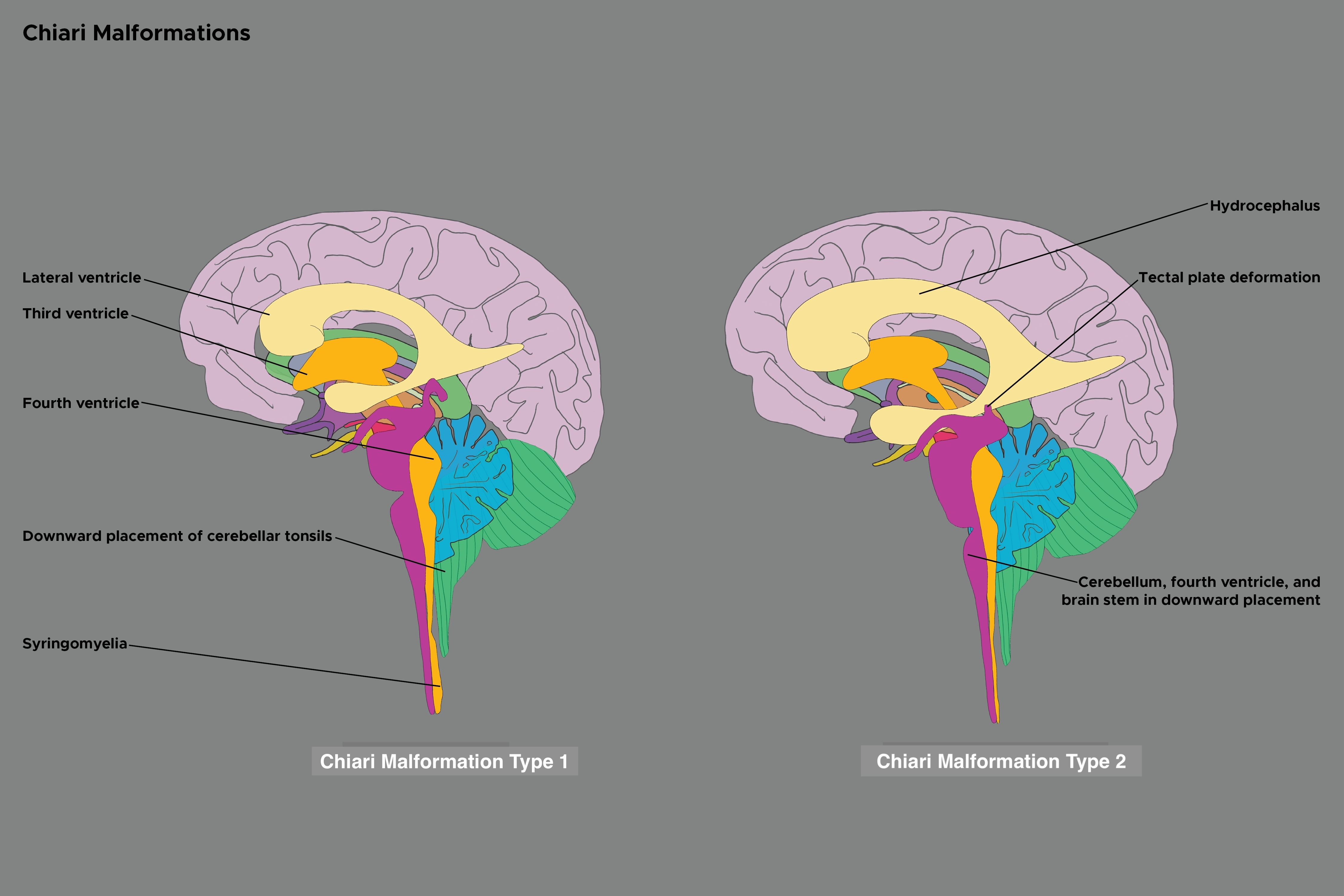 Illustration of Chiari Malformations. CM types I and II.