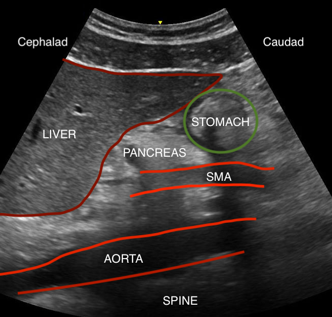 Gastric ultrasound anatomy, including liver, pancreas, stomach, superior mesenteric artery, aorta, and spine.