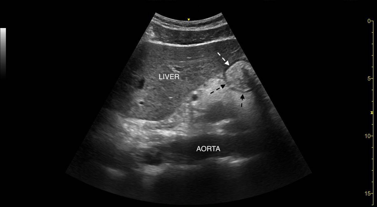 Gastric ultrasound image highlighting hypoechoic muscular layer of stomach.