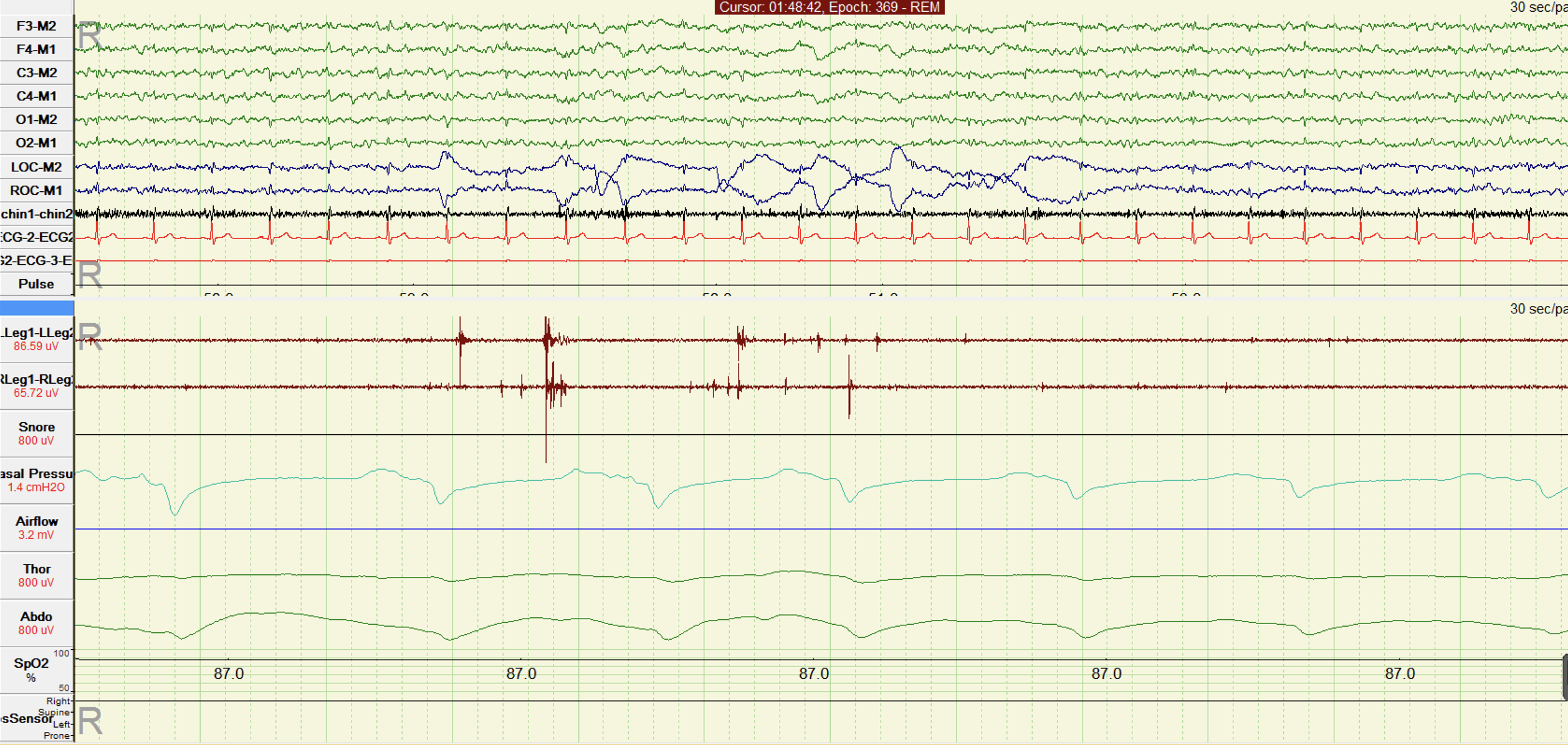 Figure depicting transient limb twitches during REM sleep consistent with REM sleep without atonia (RSWA).