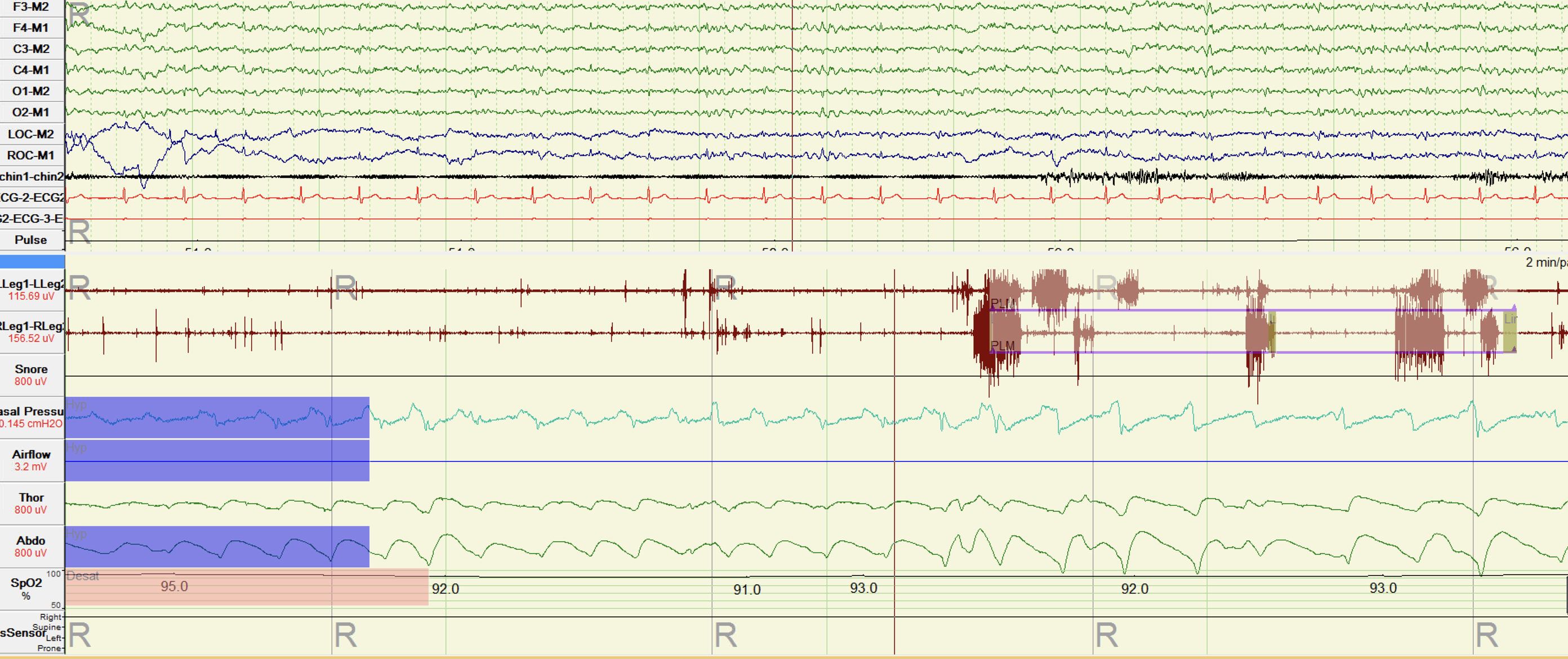 Figure depicting sustained increase in chin electromyography (EMG) and several limb twitches during REM sleep consistent with REM sleep without atonia (RSWA)