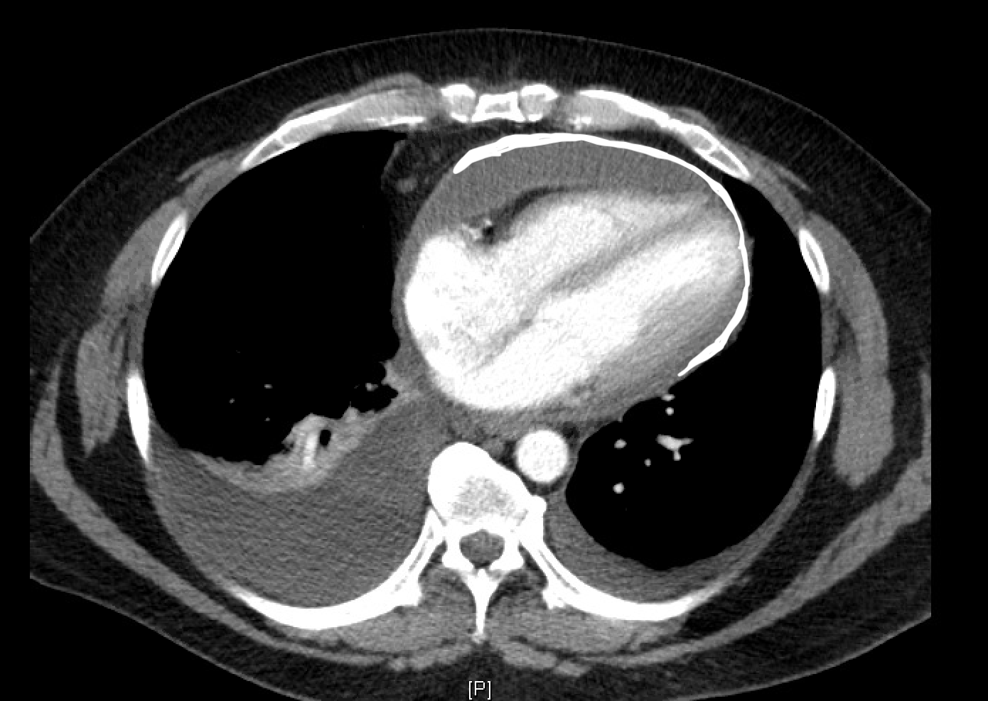 Pericardial calcification and pericardial thickening (maximum anterior thickness 2