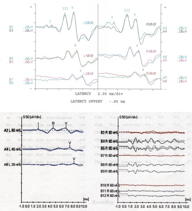 Normal ABR in top figure with prominent peaks seen from testing in both ears