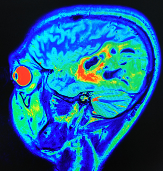 Perfusion mode CT brain showing hemorrhagic infarction along the territory of vein of Labbe