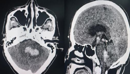 Cerebellar hematoma