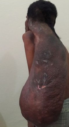 Solitary giant neurofibroma