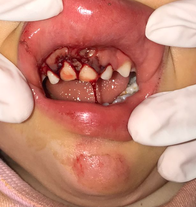 Alveolar fracture of the anterior segment showing displaced primary teeth.