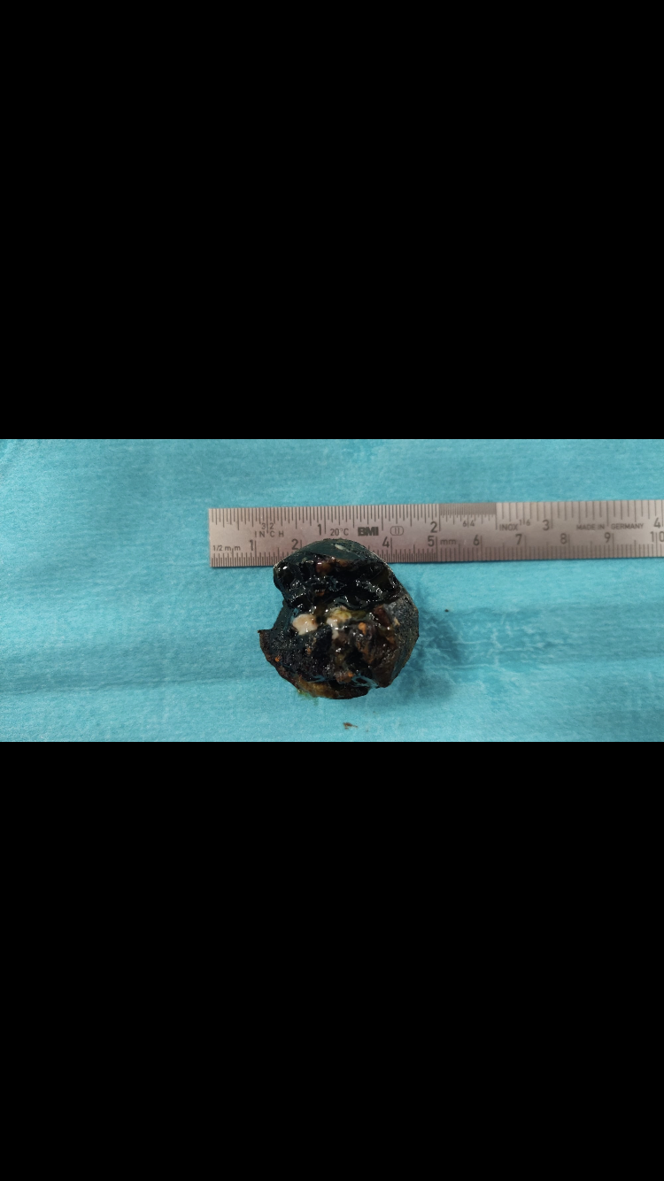 <p>Gallstone Ileus in the Jejunum