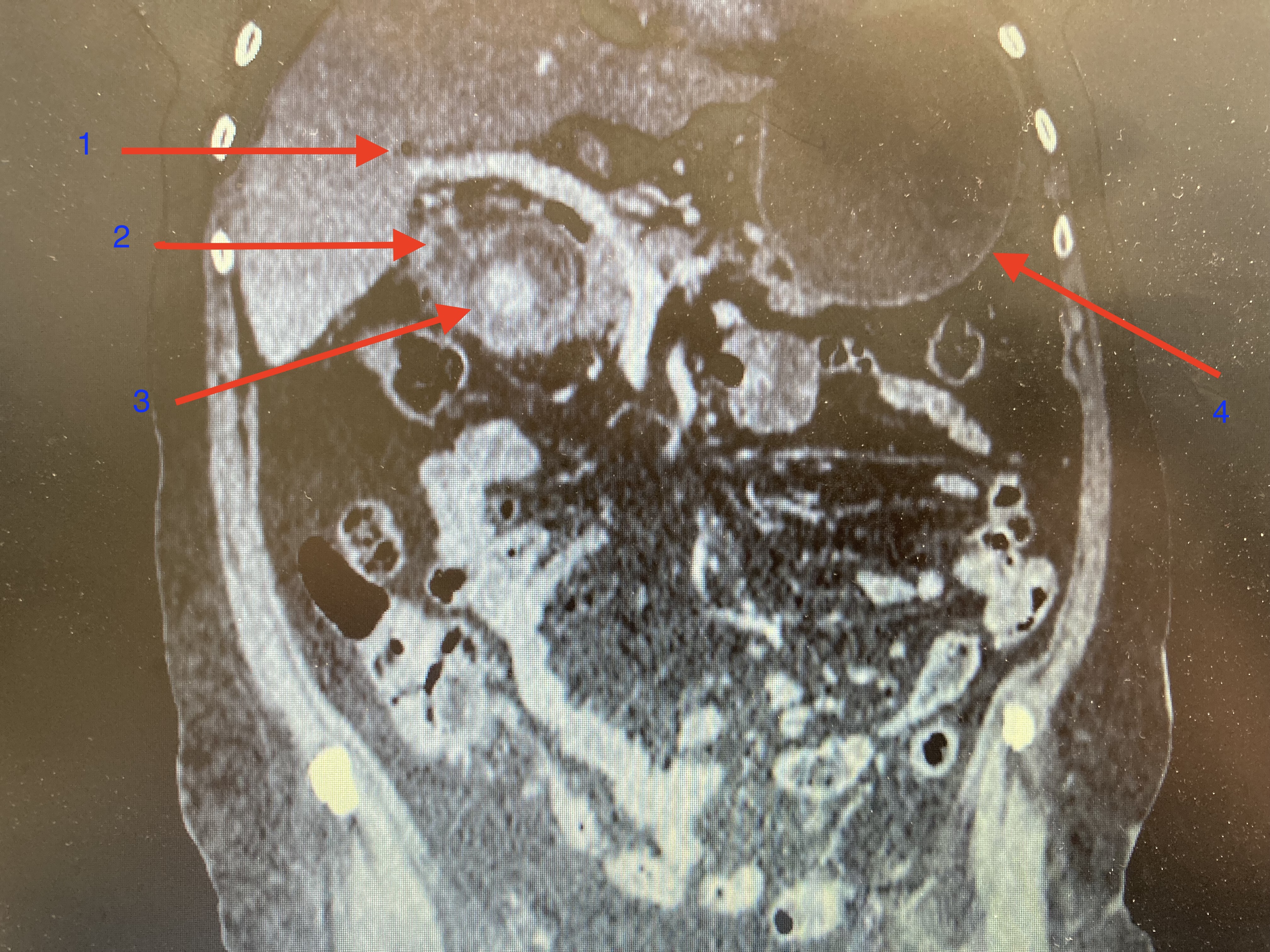 <p>Bouveret Syndrome With Rigler Triad