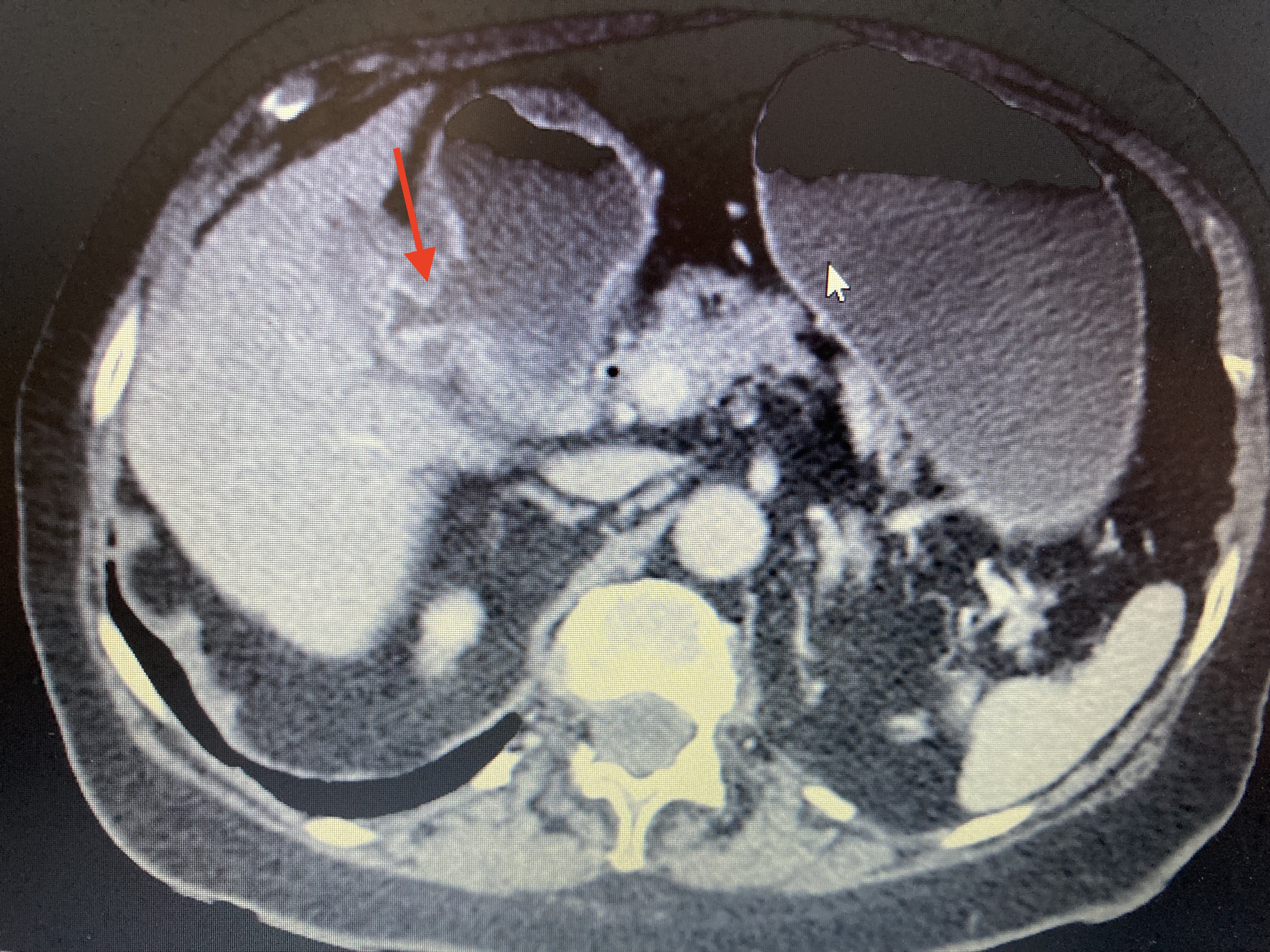 <p>Computed Tomography of the Abdomen, Cholecystoduodenal Fistula