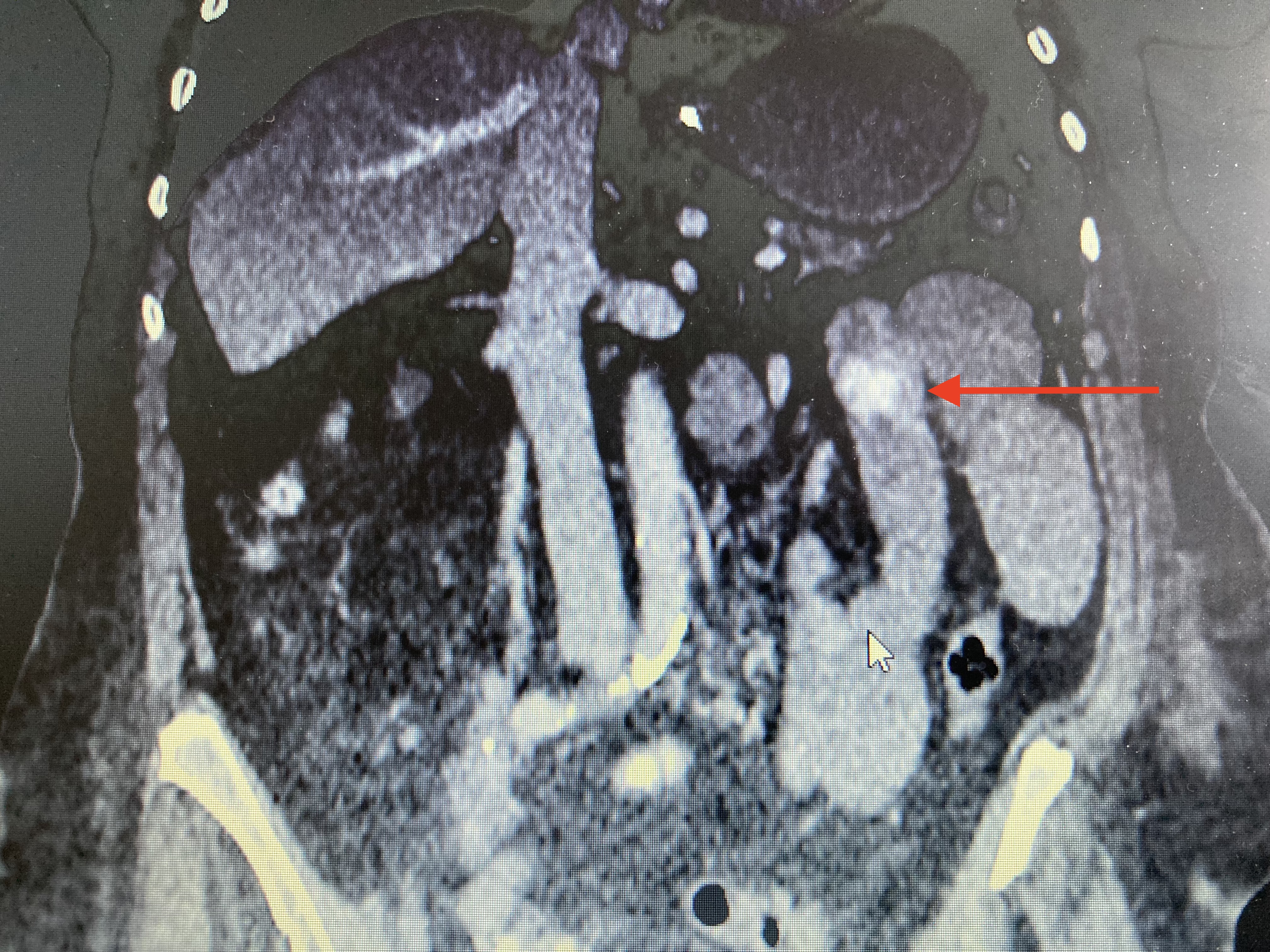 <p>Migrated Gallstone After Endoscopic Lithotripsy