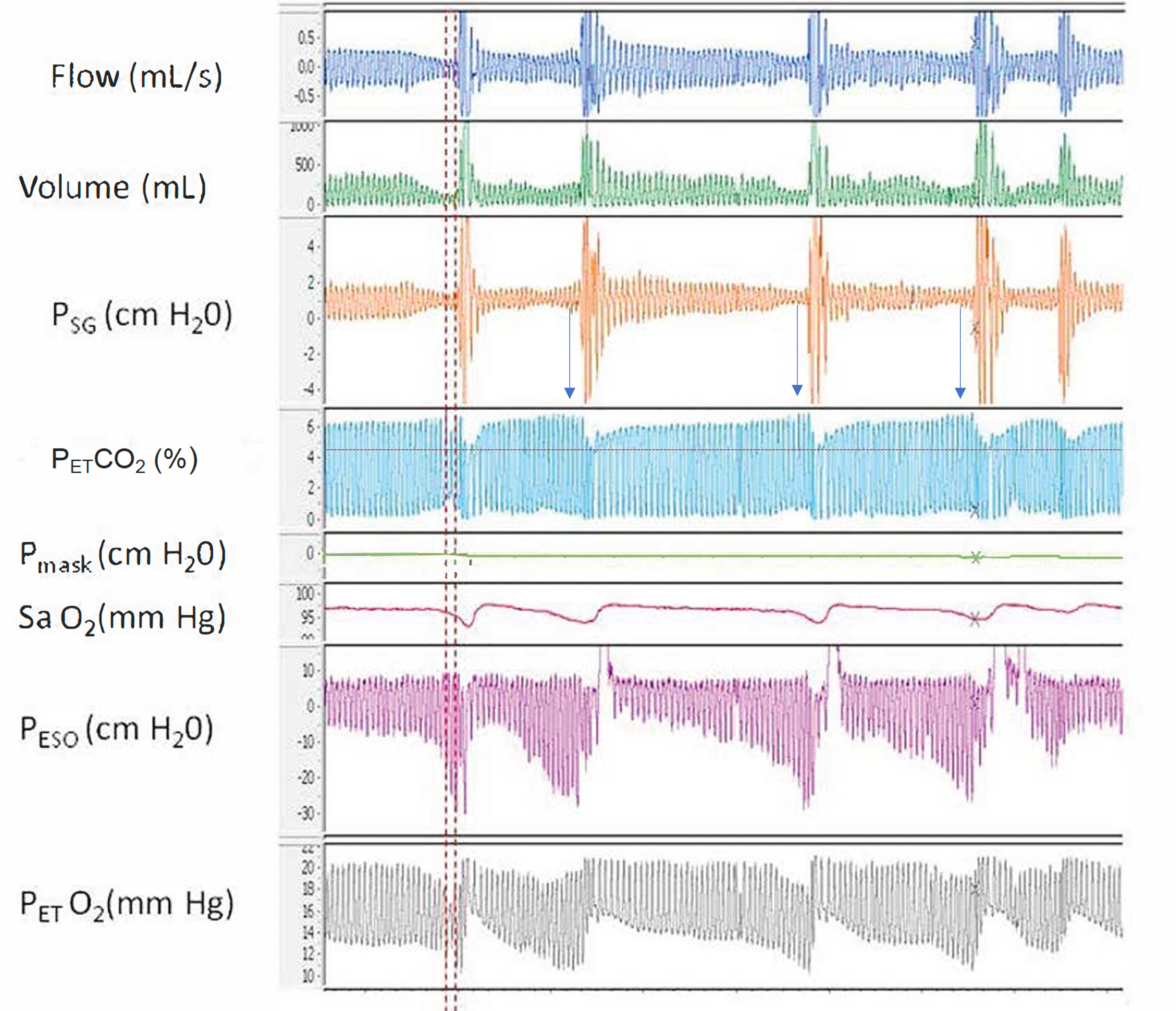 A polygraph depicting the relationship between increased airway resistance during respiratory events and increased end-tidal CO2 (PETCO2) and alternating periods of hypoventilation and hyperventilation corresponding to hypopnea and hyperpnea respectively throughout sleep