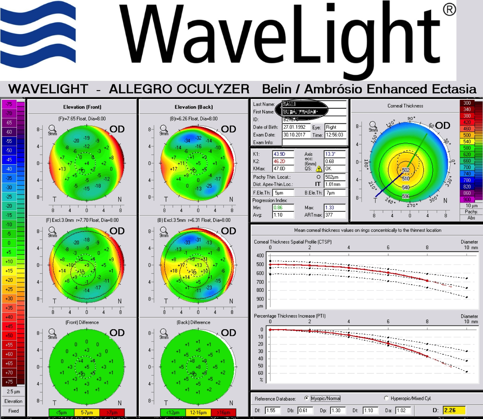 Belin Ambrosio Enhanced Ectasia Display: The display is to combine elevation based and pachymetric corneal evaluation in an all-inclusive exhibition