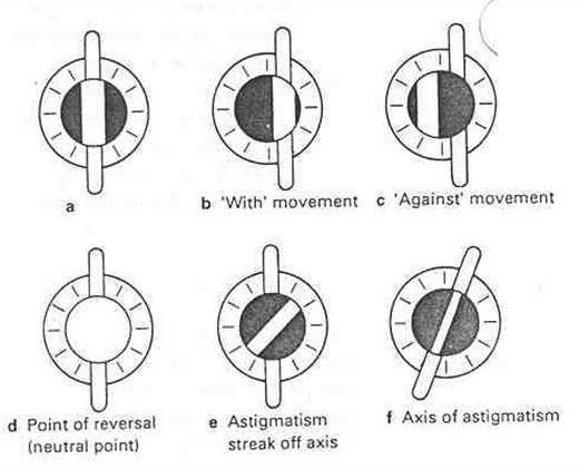 Steps of Retinoscopy