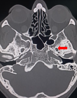 <p>Foramen Ovale.</p>