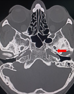 <p>Foramen Spinosum.</p>