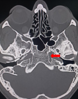 <p>Foramen Lacerum.</p>